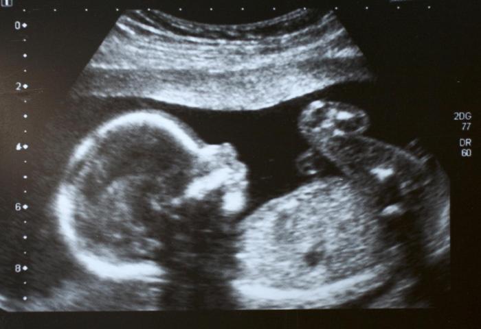 Baby Growth Scan - Anytime After 6 Weeks  (Incl Gender  after 16 weeks)